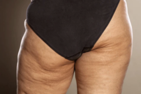 At what age do females get cellulite?