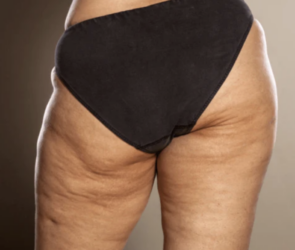 At what age do females get cellulite?