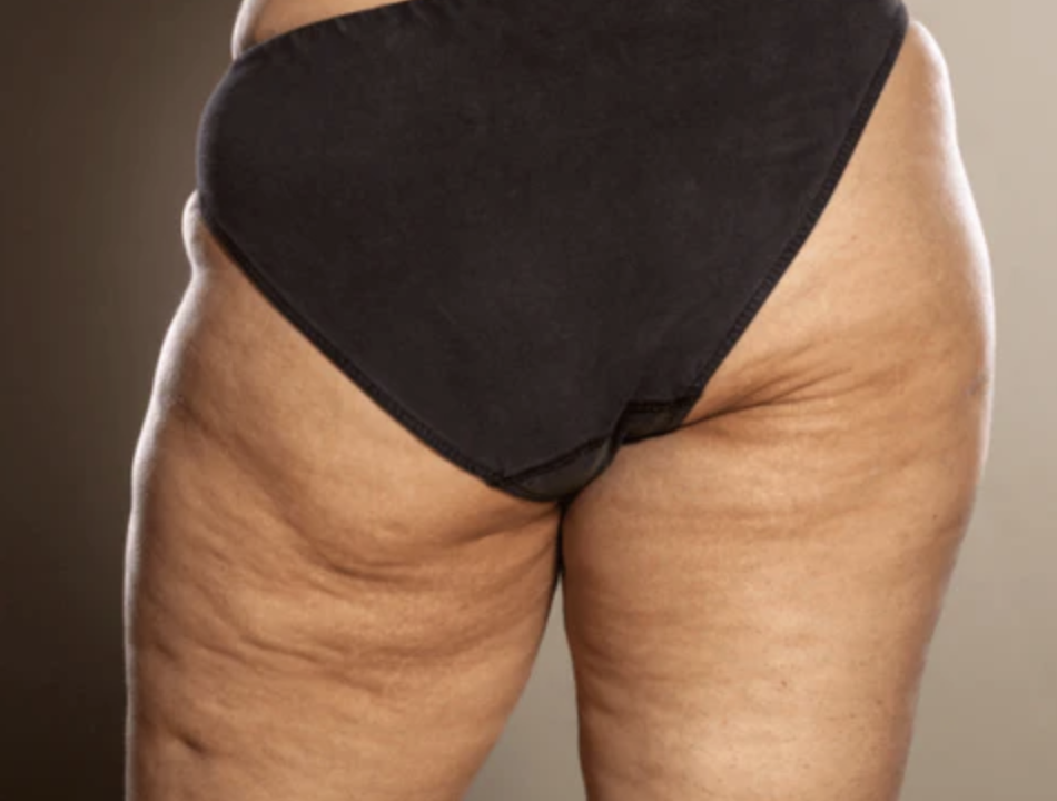At what age do females get cellulite?