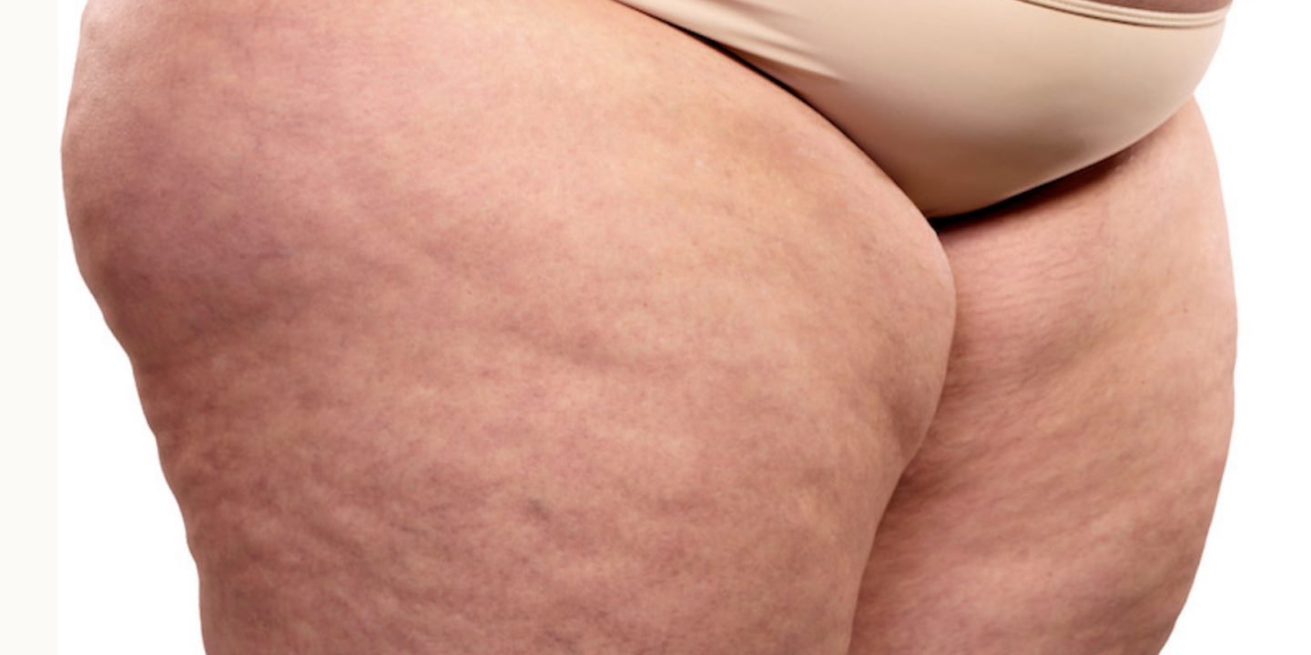 Causes of Cellulite
