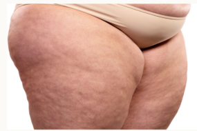 Causes of Cellulite