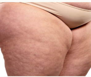 Causes of Cellulite