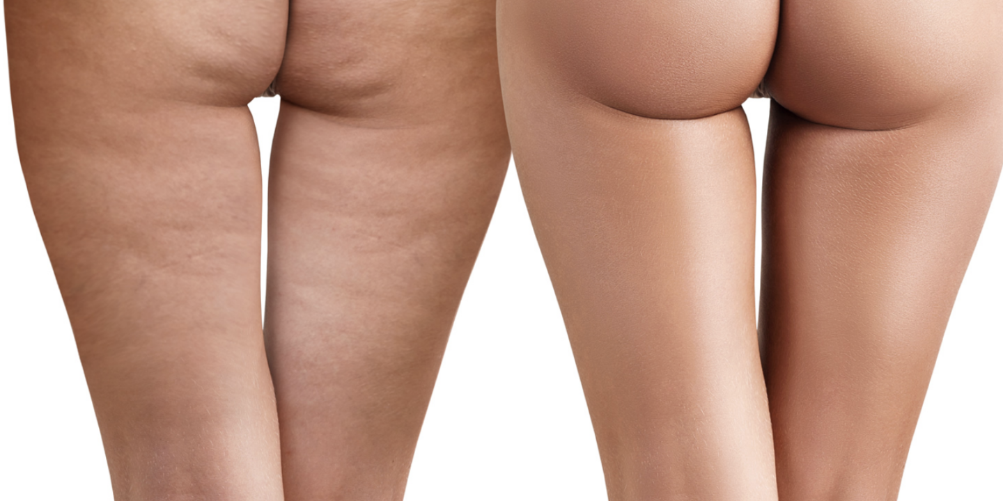Cellulite