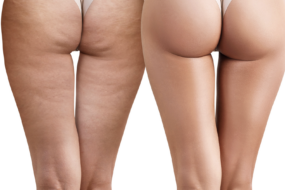 Cellulite