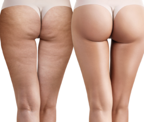 Cellulite