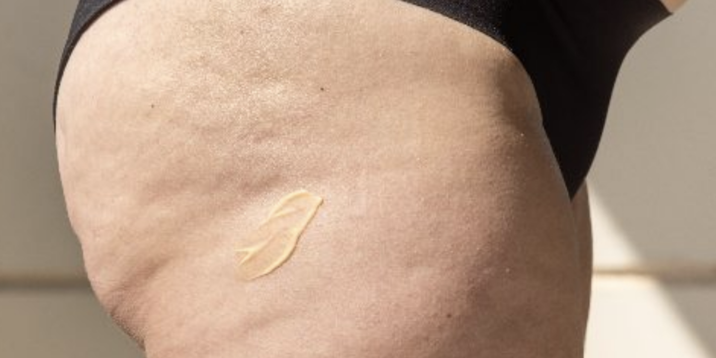 Cellulite vs Cellulitis