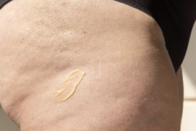 Cellulite vs Cellulitis