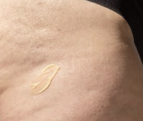 Cellulite vs Cellulitis