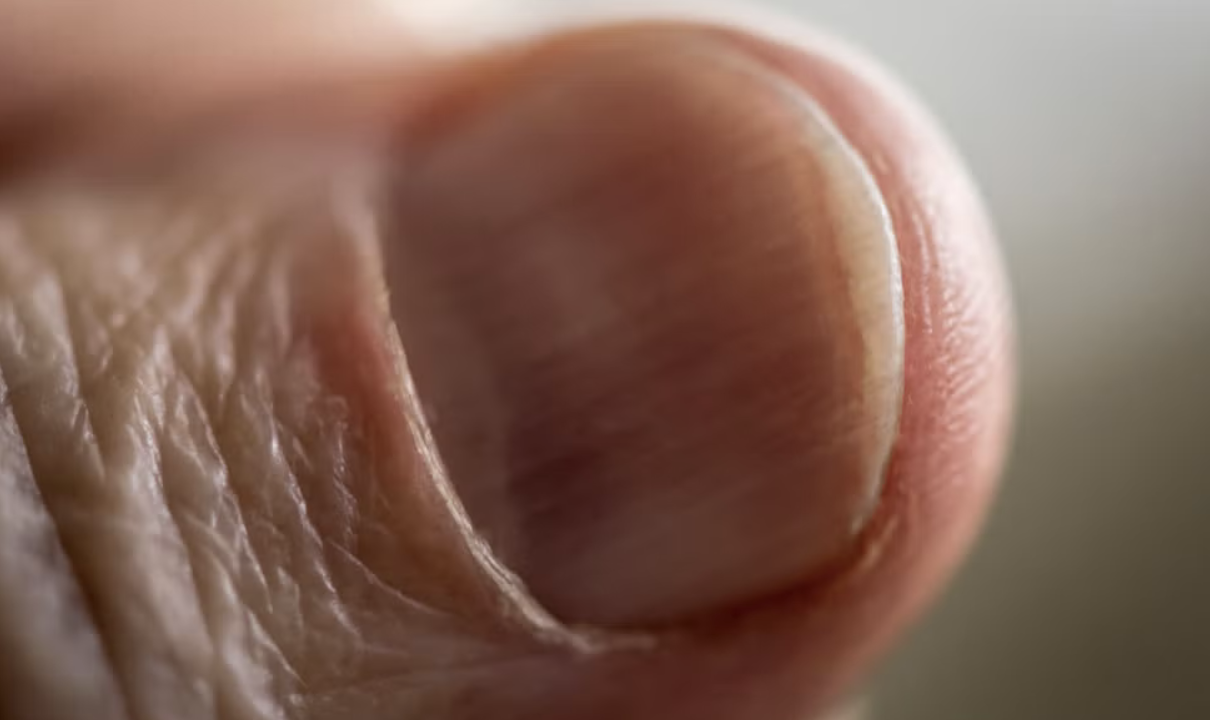 Common Nail Disorders