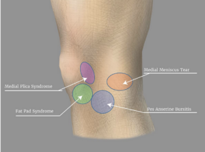 Diagnosing Joint Pain