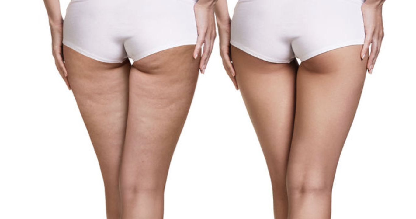 Does cellulite go away when you lose weight?