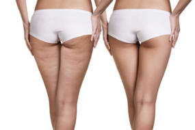 Does cellulite go away when you lose weight?