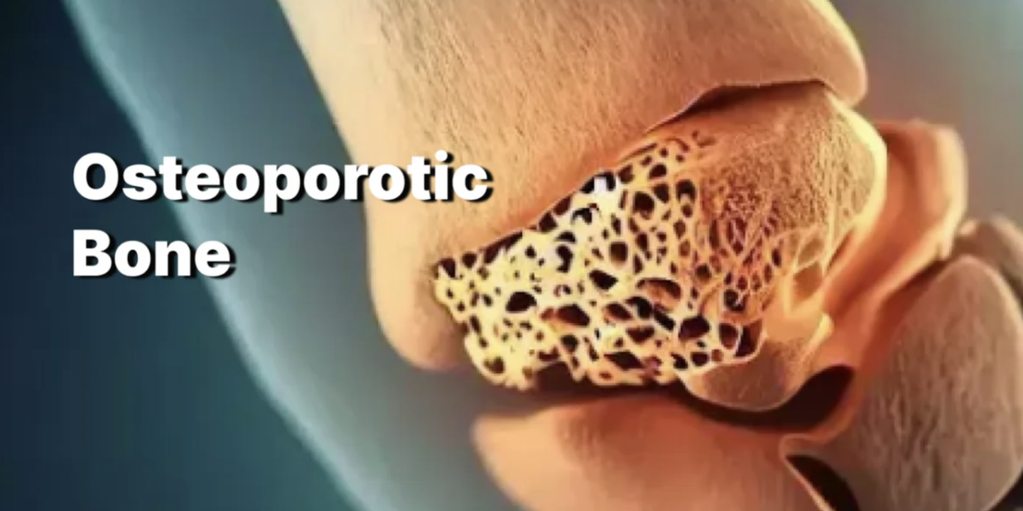 Menopause and Bone Health: Preventing Osteoporosis