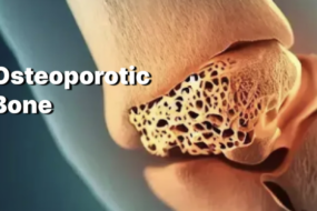 Menopause and Bone Health: Preventing Osteoporosis