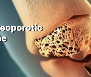 Menopause and Bone Health: Preventing Osteoporosis