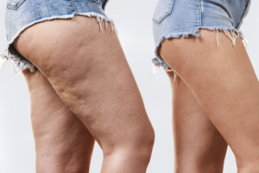 Prevent Cellulite Formation