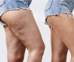 Prevent Cellulite Formation