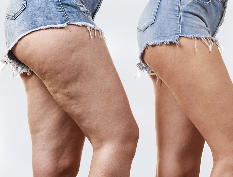 Prevent Cellulite Formation