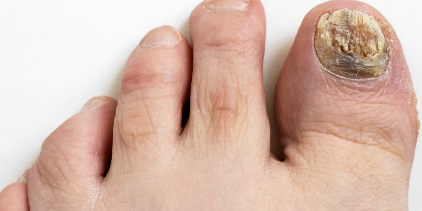 Toe fungus
