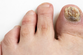 Toe fungus