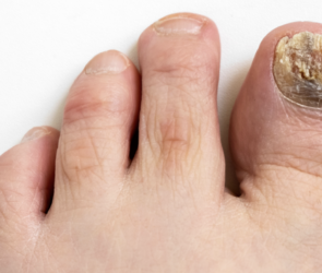 Toe fungus