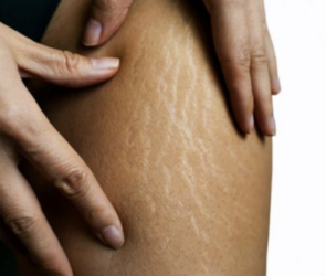 Types of Cellulite
