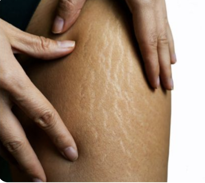 Types of Cellulite