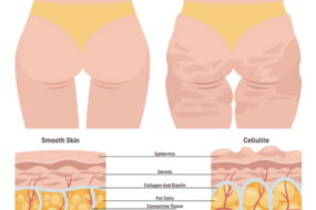 Aesthetics of Cellulite: Perception and Reality 12 Understanding the Aesthetics of Cellulite