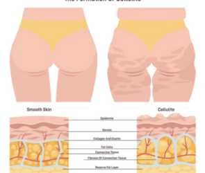 Understanding the Aesthetics of Cellulite