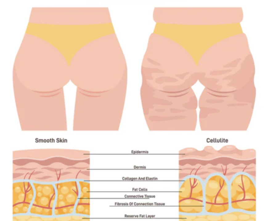 Understanding the Aesthetics of Cellulite