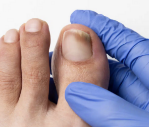 When to See a Doctor for Toe Fungus