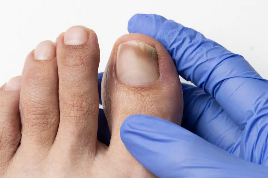 When to See a Doctor for Toe Fungus