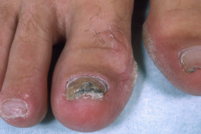 best nail fungus treatment