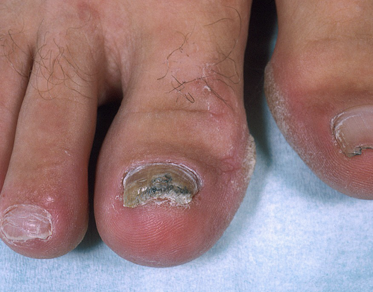 best nail fungus treatment