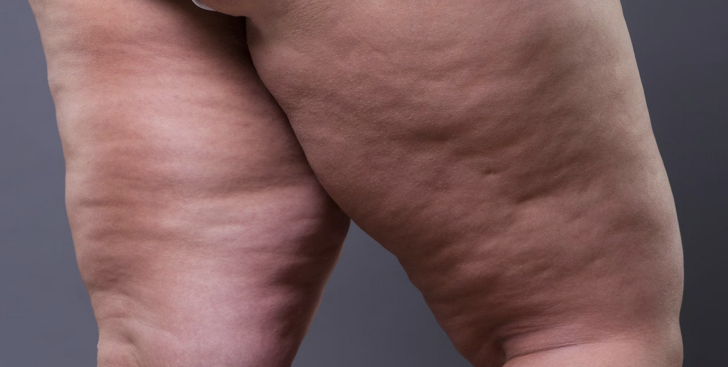 cellulite causes