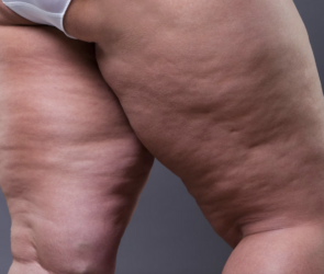 cellulite causes