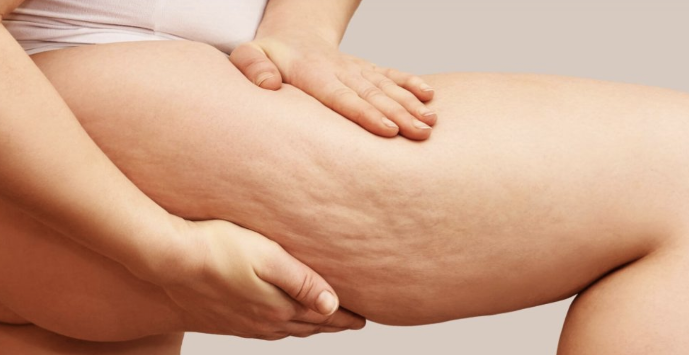 cellulite on thighs