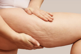 cellulite on thighs