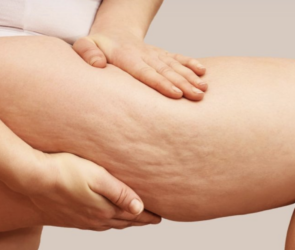 cellulite on thighs