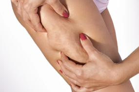 cellulite prevention