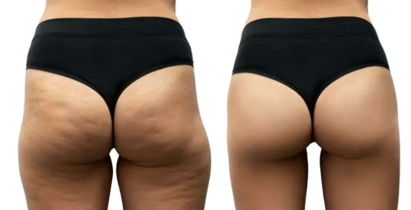 cellulite procedures
