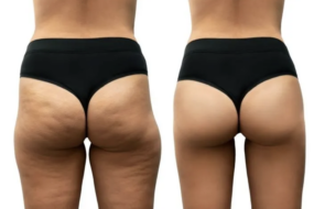 cellulite procedures