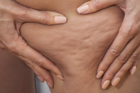 cellulite therapy