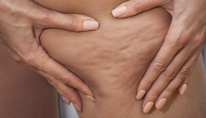 cellulite therapy