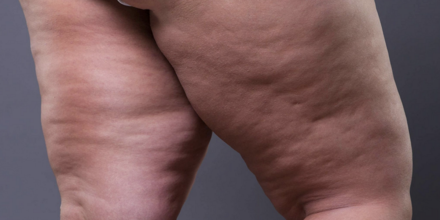 cellulite treatments