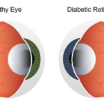 eye care and diabetes