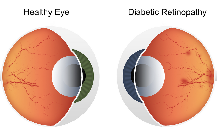 eye care and diabetes