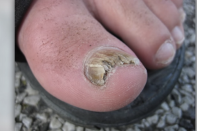 home remedies for toe fungus