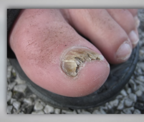 home remedies for toe fungus