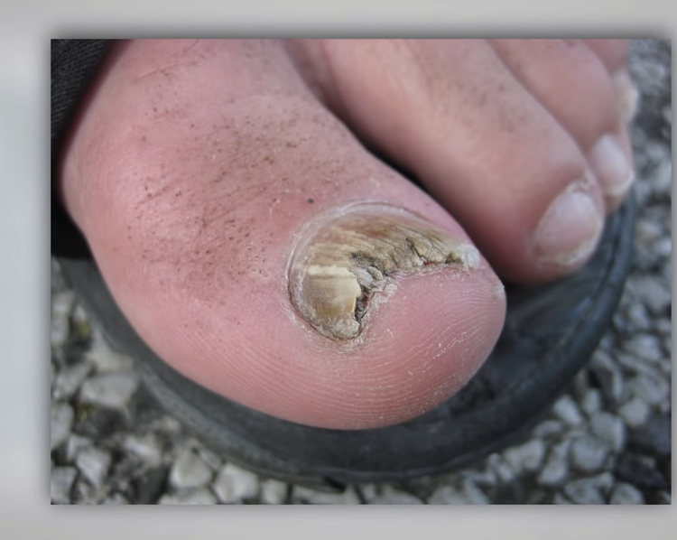 home remedies for toe fungus